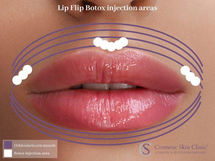 Boost with Botox Lip Flip