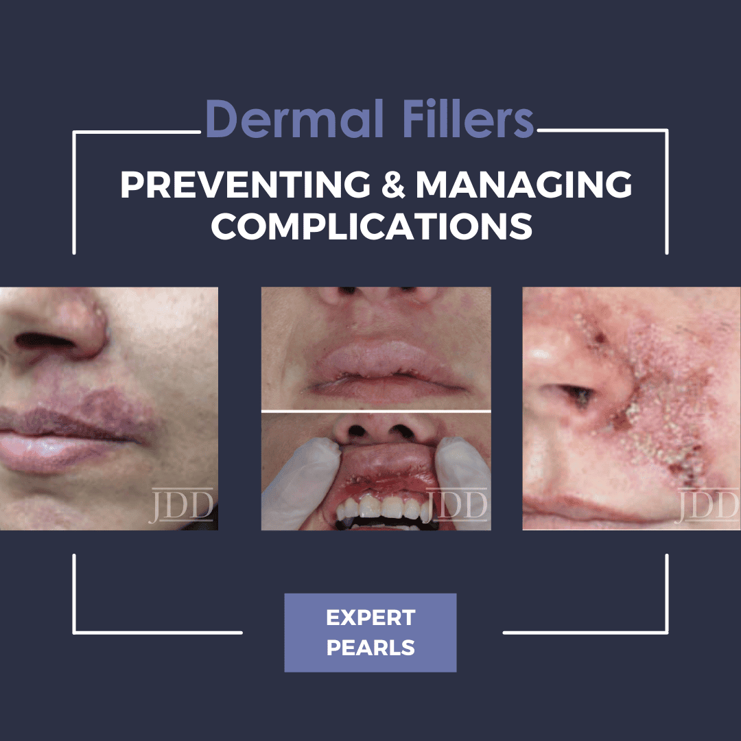 Common Lip Filler Complications