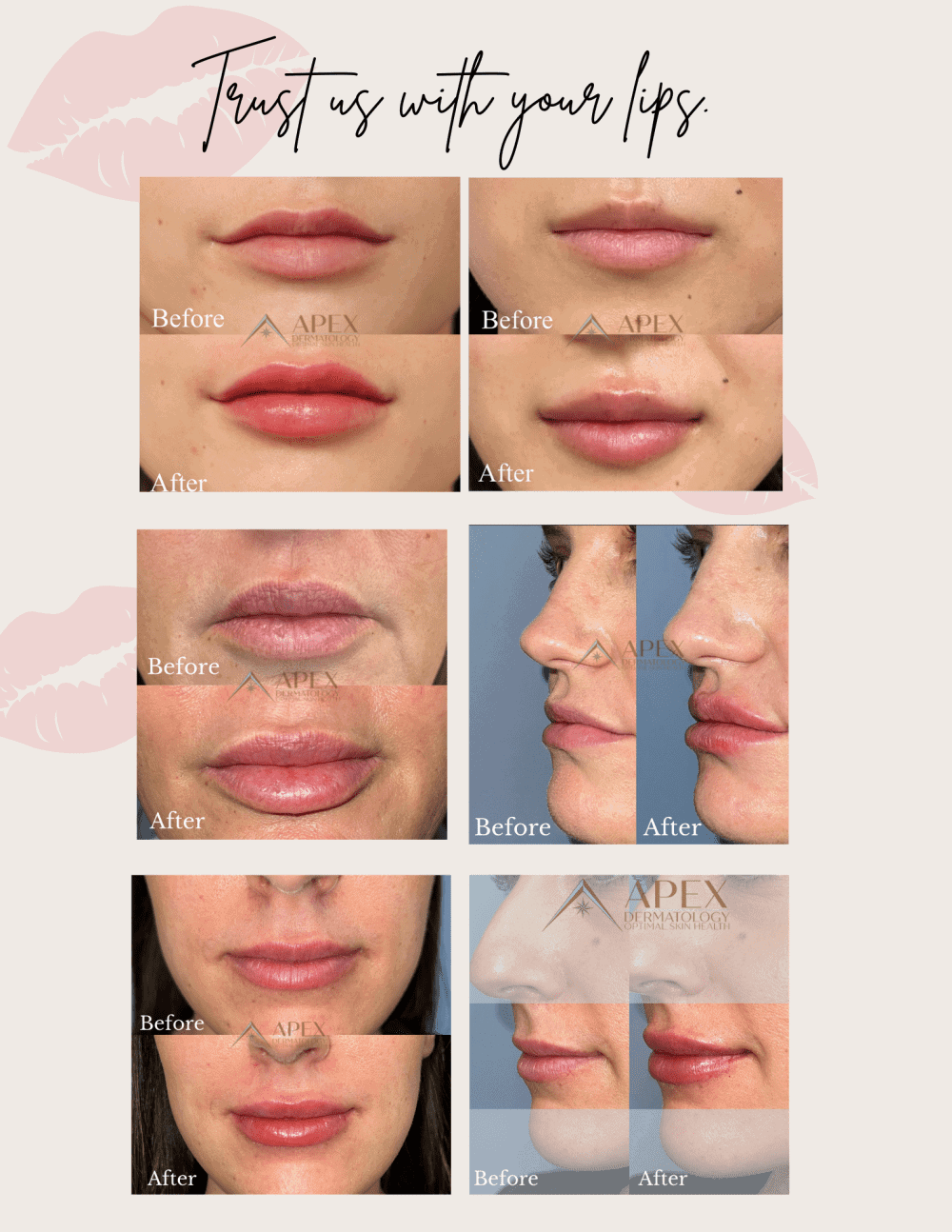 Common Types Lip Fillers