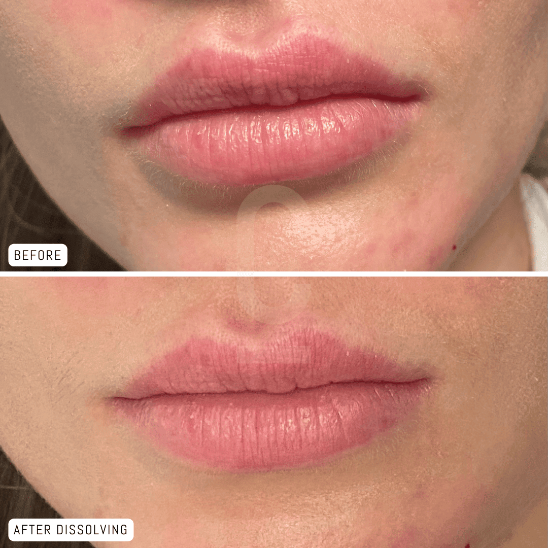 Correcting Unwanted Lip Filler Results