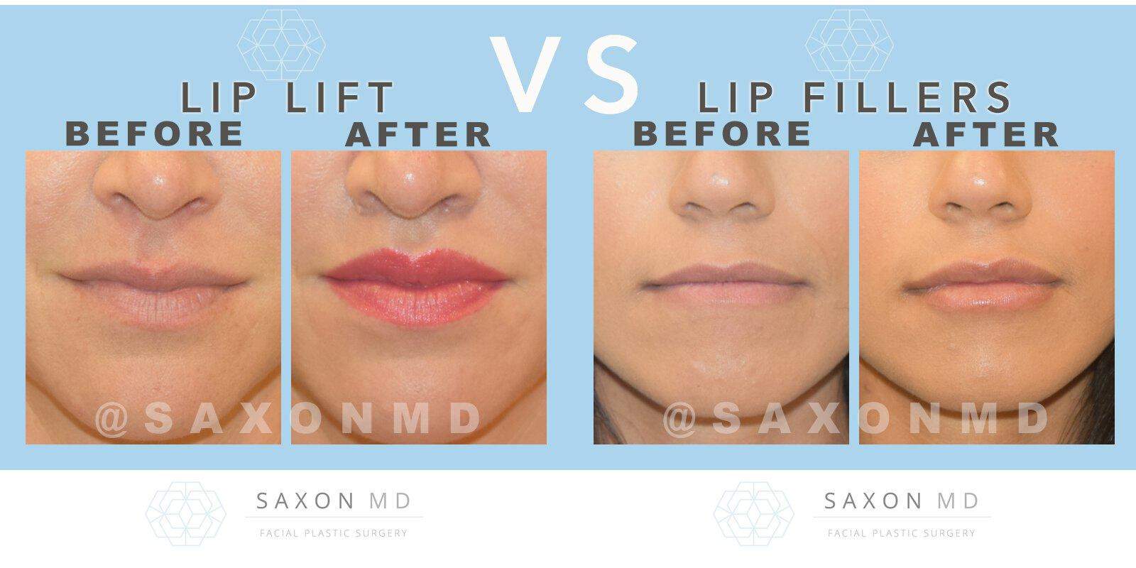 Dermal Fillers Versus Lip Fillers