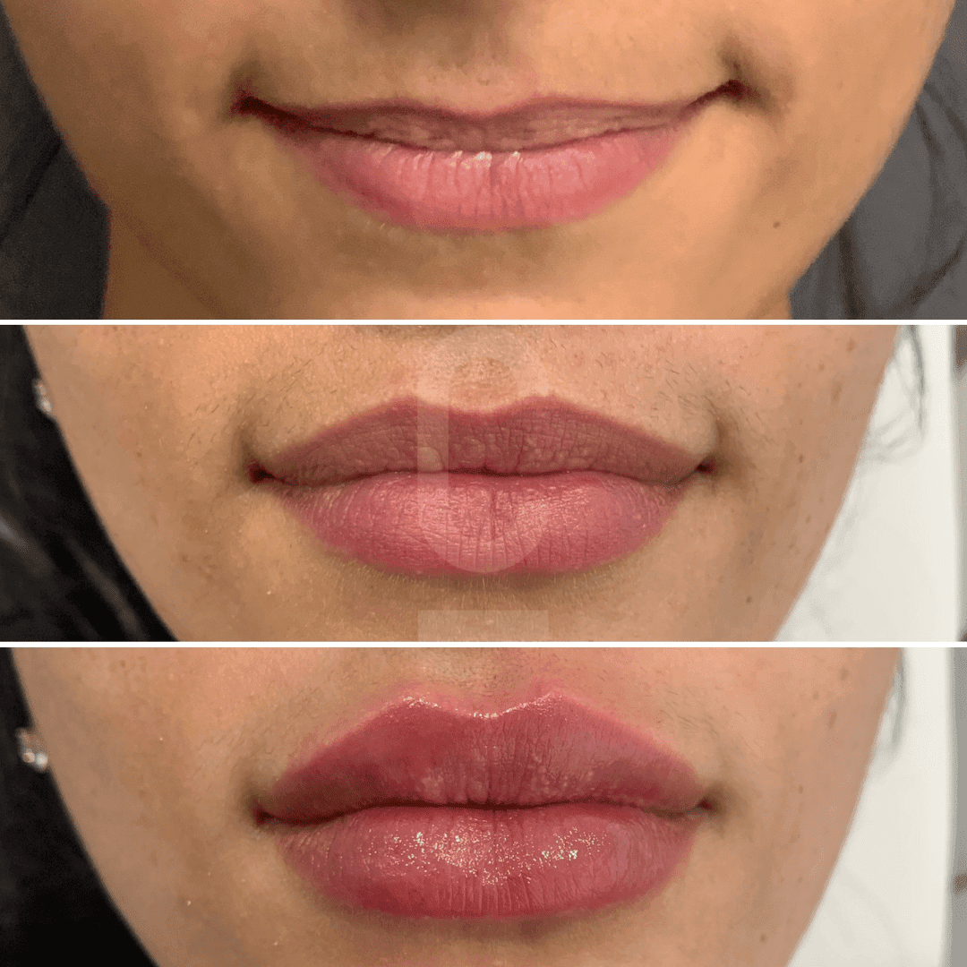 Finding Right Doctor Lip Enhancement