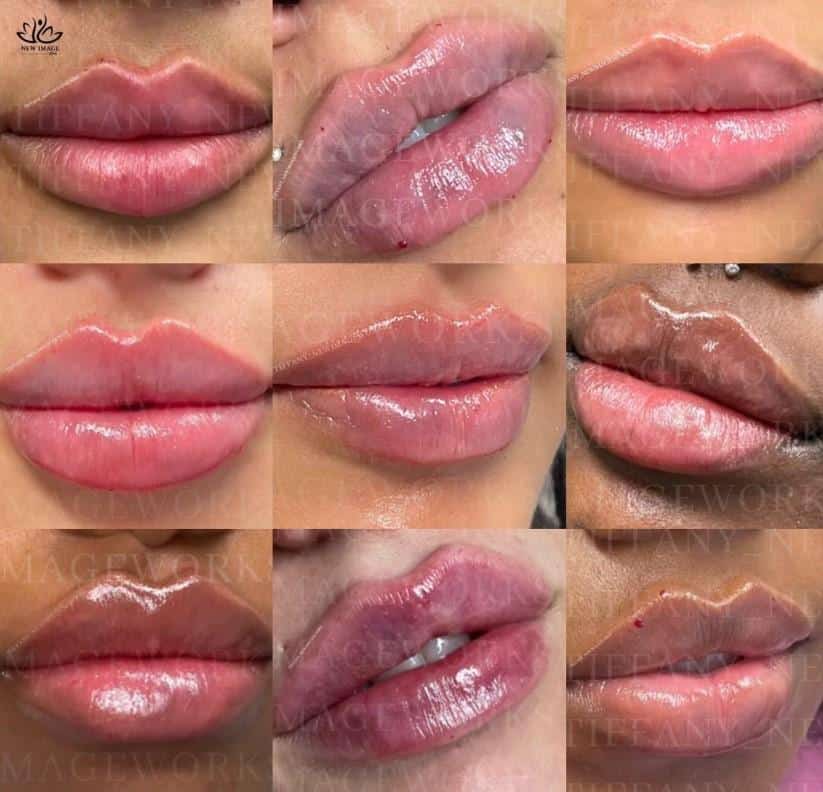 Imaging Techniques Lip Filler Treatments