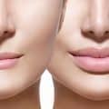 Lip Augmentation Versus Fillers: A Comprehensive Review