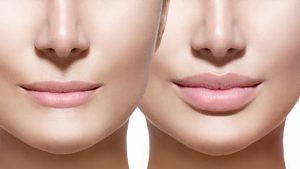 Read more about the article Lip Augmentation Versus Fillers: A Comprehensive Review