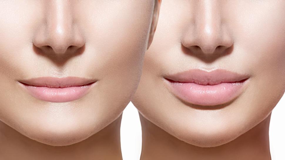 You are currently viewing Lip Augmentation Versus Fillers: A Comprehensive Review