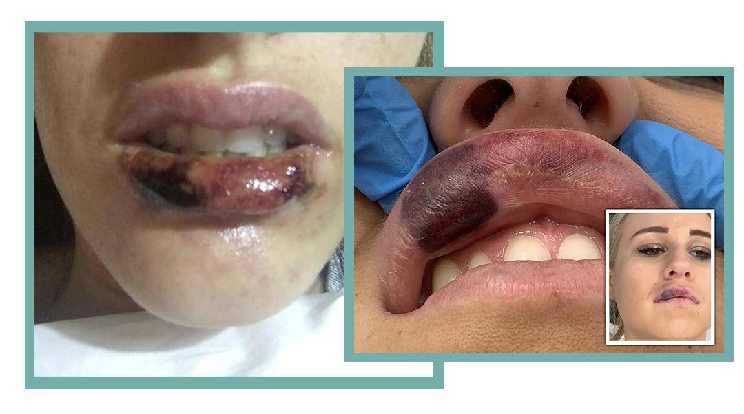 Read more about the article The Truth About Lip Filler Complications