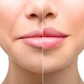 Understanding the Healing Process for Lip Fillers