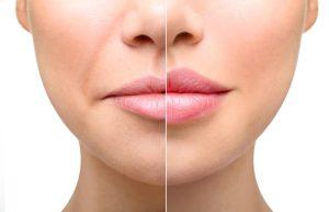 Read more about the article Understanding the Healing Process for Lip Fillers