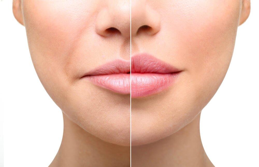 You are currently viewing Understanding the Healing Process for Lip Fillers