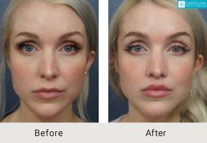 Read more about the article Are Permanent Lip Injections Really Permanent?