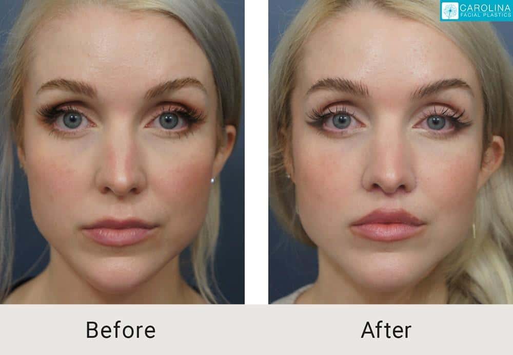 You are currently viewing Enhancing Lips Naturally: A Permanent Solution