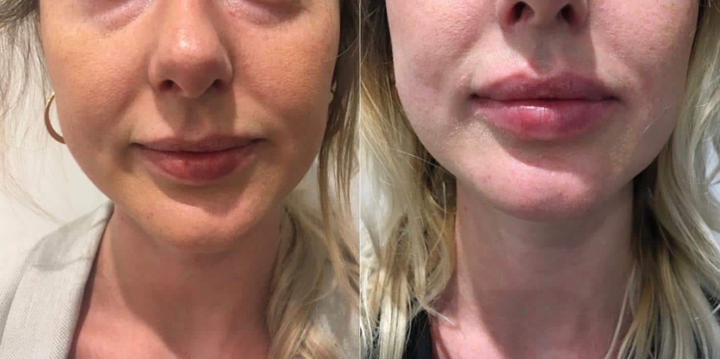 Personal Testimonies Lip Fillers