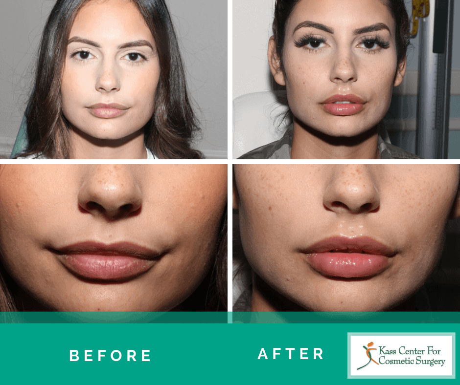 Procedure Lip Augmentation