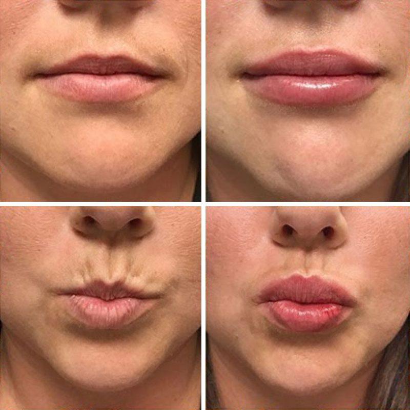 Purpose Lip Fillers