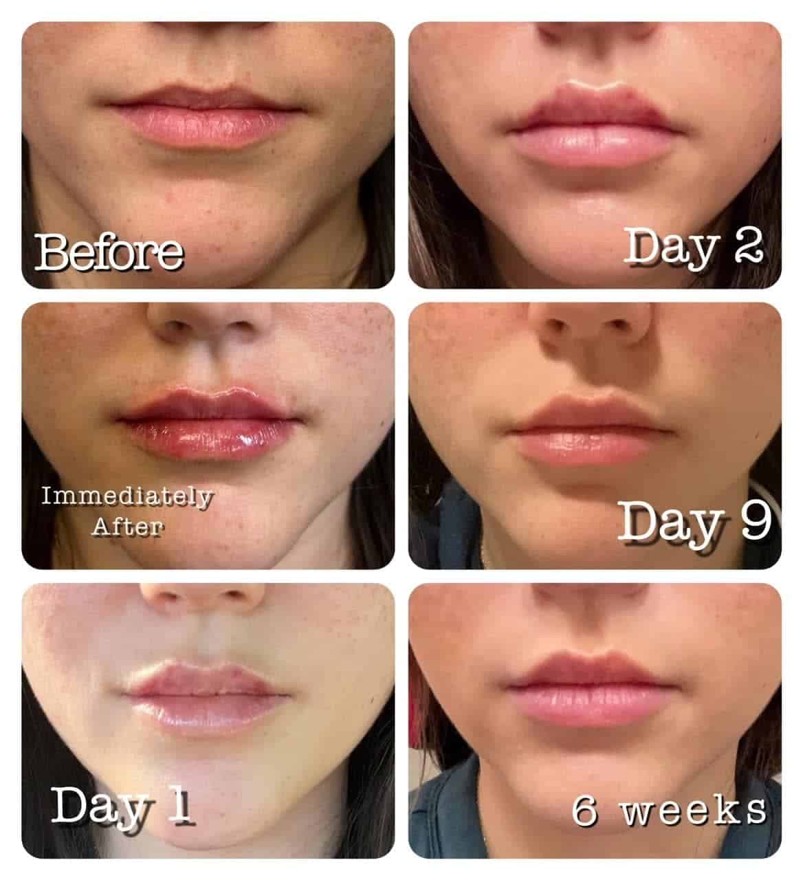 Recovery Process PostLip Filler