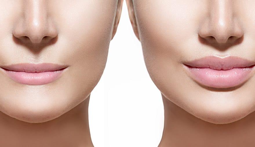 Read more about the article Options for People With Thin Lips