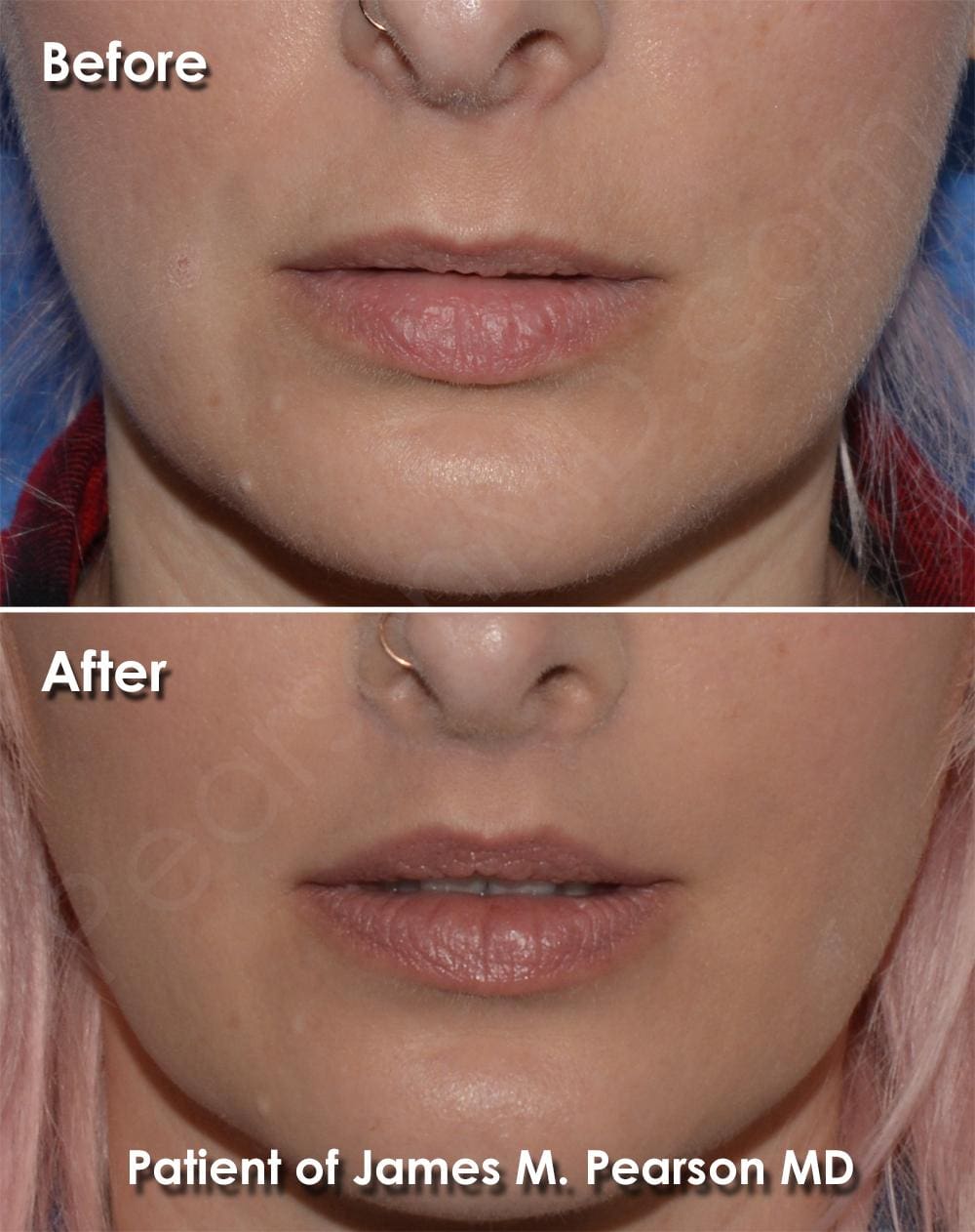 Try Lip Lift Procedure